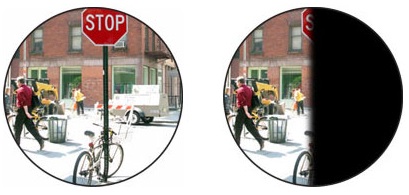 A comparison of a normal view of a street and hemianopia, where there is in this case no right field of vision