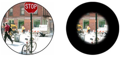 A comparison of normal vision of a street scene with Usher Syndrome, where only central vision is present